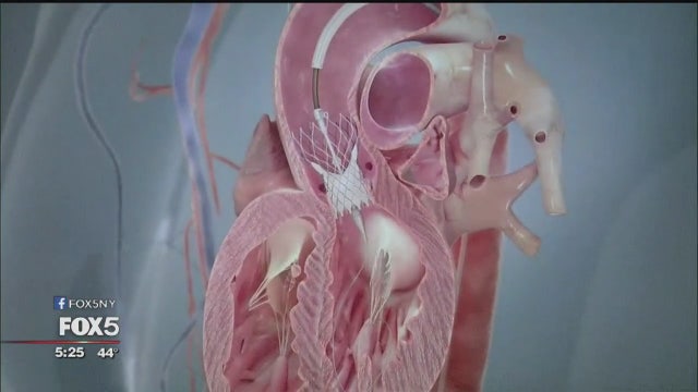 New procedure may replace open-heart surgery