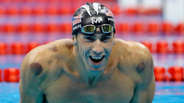 Ancient cupping tradition has 'no good science behind it'