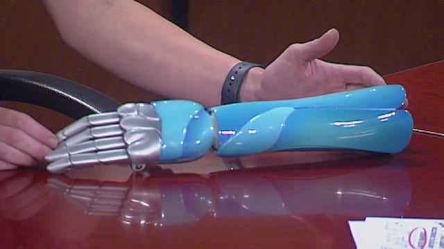 Prosthetic limbs at a lower cost via 3D printing