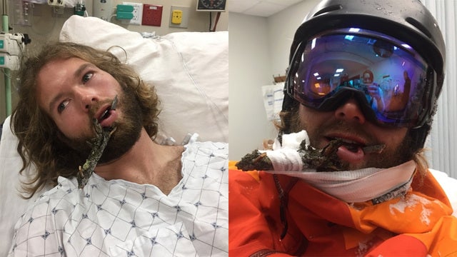 Ski instructor impaled by 18-inch branch