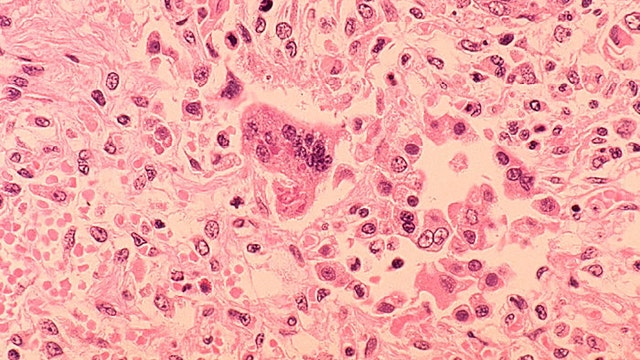 NJ health officials warn of possible measles exposure at Newark airport