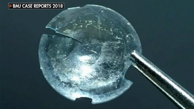 Lost contact found in woman's eyelid 28 years later