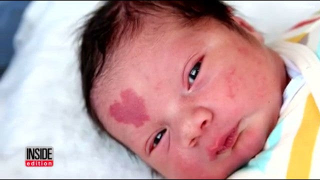Baby born with heart-shaped birthmark on forehead