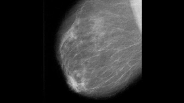 Gene test finds which breast cancer patients can skip chemo