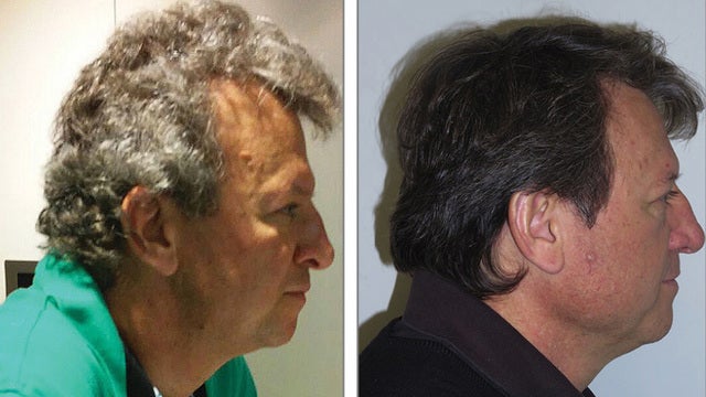 Cancer patients' gray hair darkened on drugs