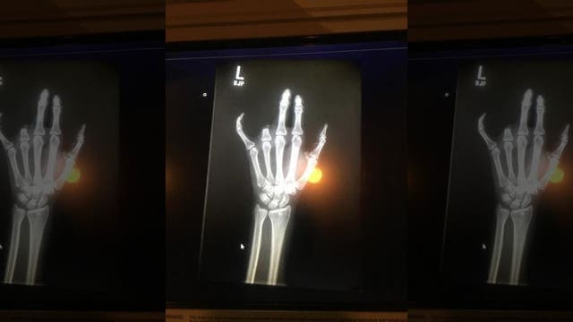 Mom loses finger in freak injury at son's baseball practice