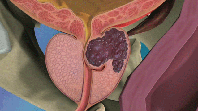 Prostate cancer: what you need to know