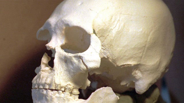 UConn loses track of 15 human skulls