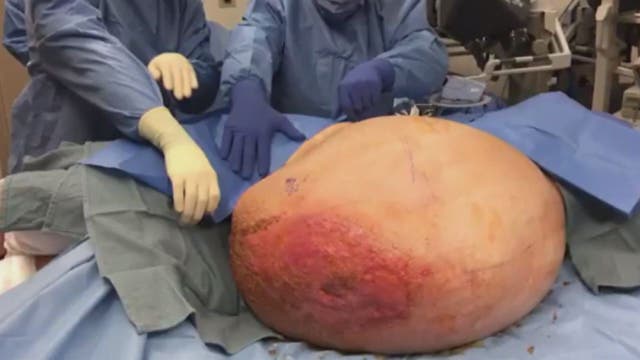 Local woman has 140 pound malignant ovarian tumor removed