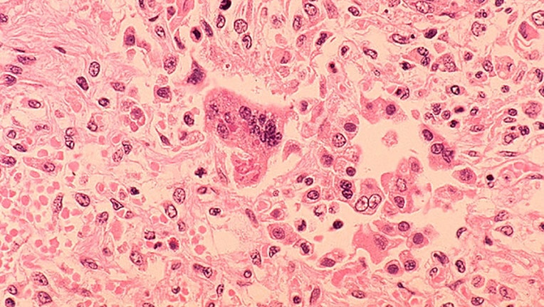 measles GETTY IMAGES-401385