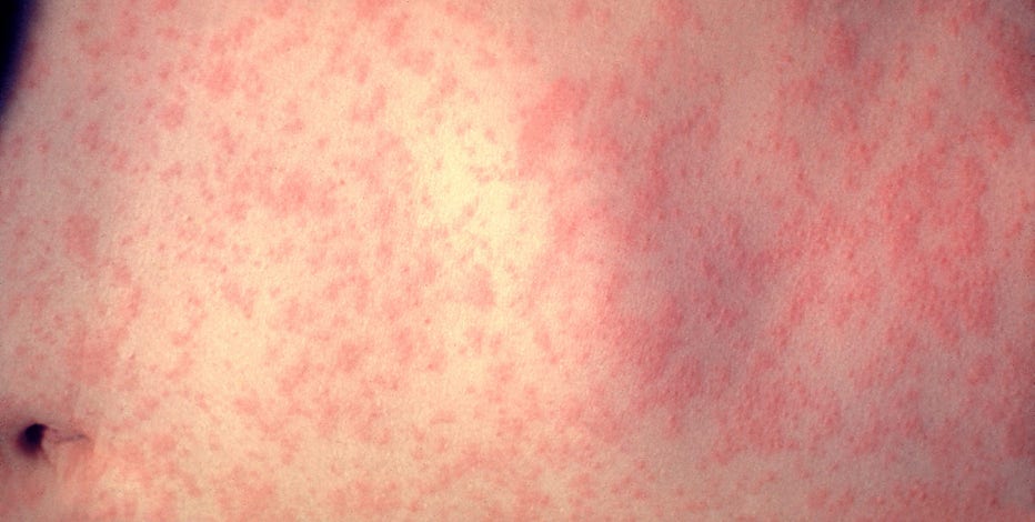 Measles cases confirmed in NJ, NY as US reports first death