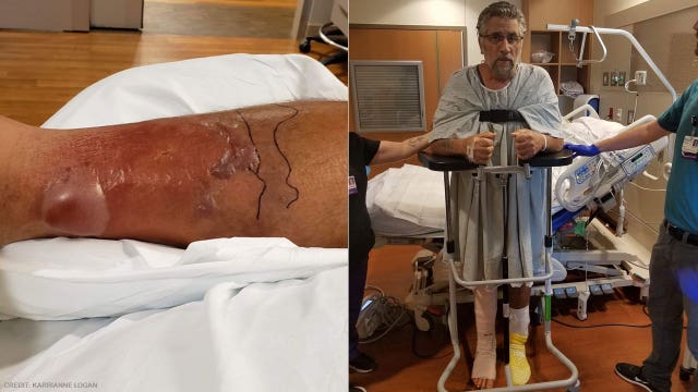 Florida man who thought he had a bad sunburn on leg nearly dies from flesh-eating bacteria