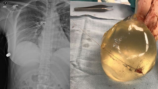 Woman's breast implants believed to save her life from bullet