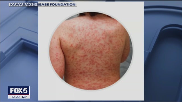 Doctors probe link between COVID-19 and kids with Kawasaki-like disease