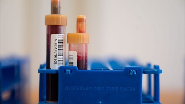 Study suggests official COVID-19 death numbers underestimate ‘full burden’ of the pandemic