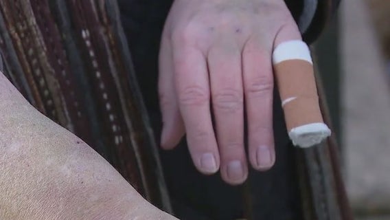 Aggressive squirrels terrorizing Queens neighborhood