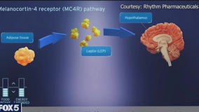 Drug helps fight obesity linked to certain genetic conditions