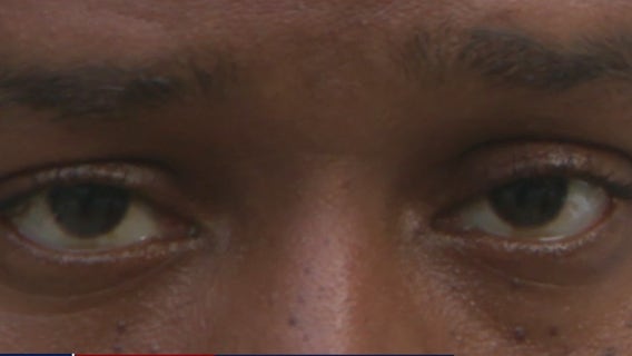 To fight eye strain from too much screen time, 'eye yoga' gains popularity