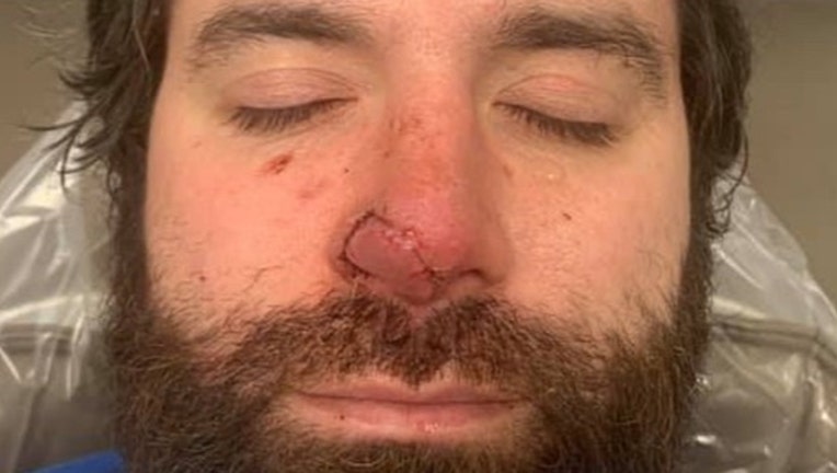 A photo from GoFundMe shows Bryan Thayer's nose.