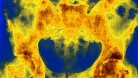 Radiation drug may improve survival rates for prostate cancer, study shows