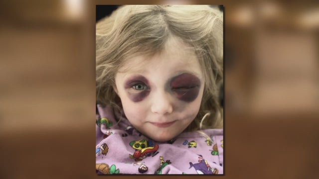 3-year-old girl survives freak accident at Parker equestrian center