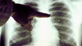 US death rates fall for lung cancer, melanoma, report says