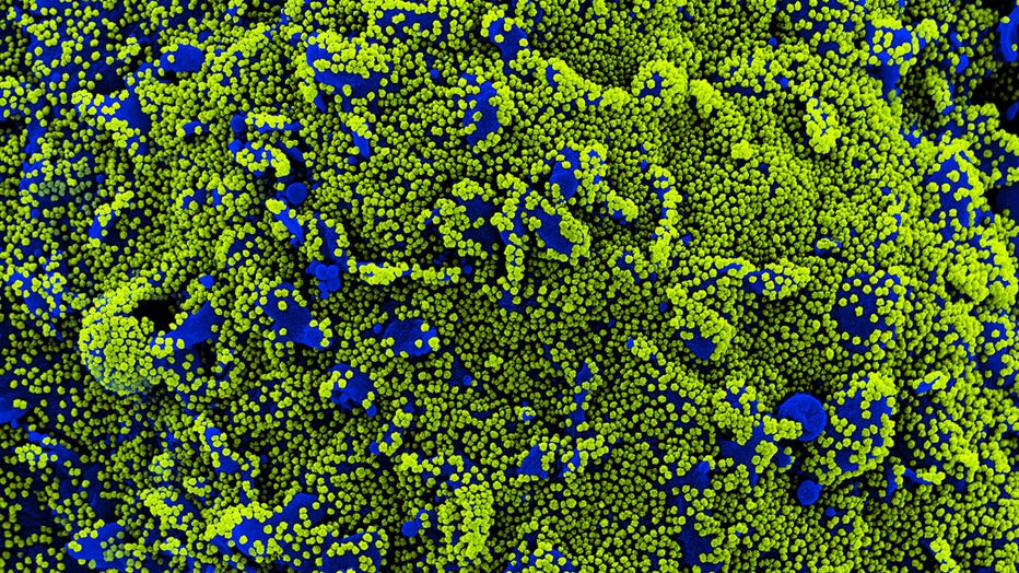 This colorized scanning electron micrograph shows a cell (blue) heavily infected with SARS-CoV-2 virus particles (green)