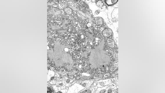 US had 5 rabies deaths last year, highest total in a decade