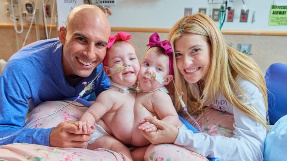 Conjoined twin girls, joined at chest, successfully separated by CHOP surgeons
