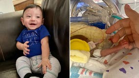 Micro-preemie born 11.5 ounces celebrates 1st birthday after 127-day stay in NICU