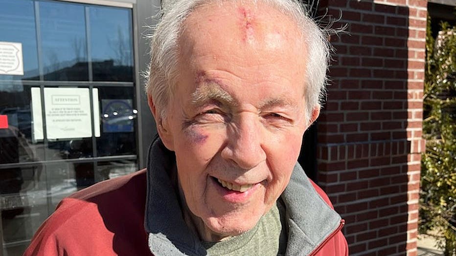 Another view of Marine veteran Ed Norton, with the facial bruises and cuts from his fall. He believes the masks that so many Americans have had to wear have been "useless." He also told Fox News Digital, "Some people get really dogmatic about masking." (Deirdre Reilly)