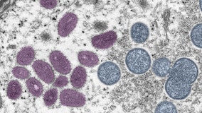 NJ resident dies of monkeypox-related causes