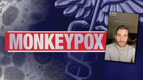 Monkeypox outbreak: Patient shares his experience