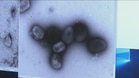 Monkeypox NYC: First juvenile case confirmed