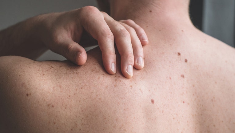 Checking benign moles. Close up detail of the bare skin on a man back with scattered moles and freckles