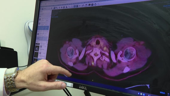 Cancer vaccines being developed at the Tisch Cancer Institute at Mount Sinai