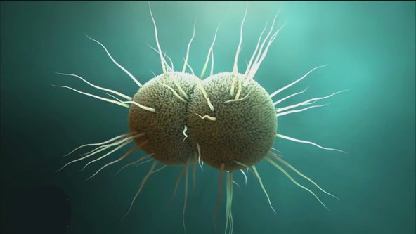 Super gonorrhea cases uncovered in the U.S.