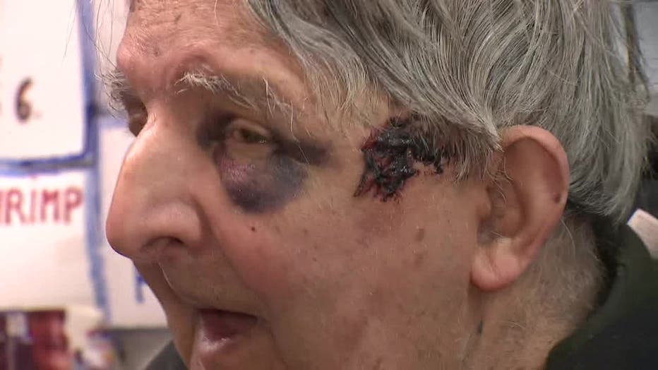 Ray Alvarez shows the injuries from his attack.