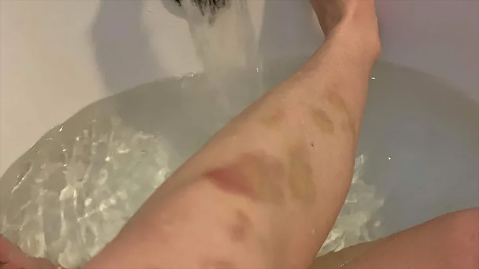 Adriana's Kuch's bruised legs after she was bullied at the local high school. (Michael Kuch)