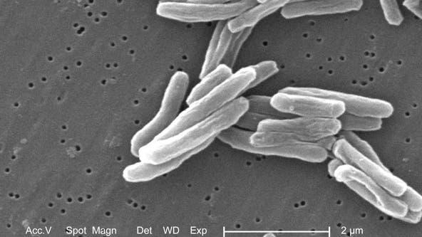 Tuberculosis cases on the rise in NY: CDC