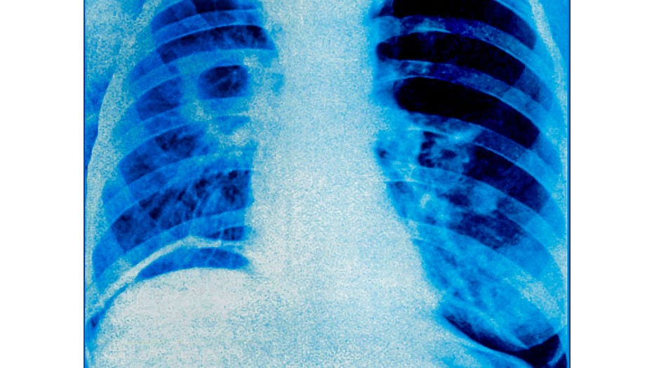 Pulmonary tuberculosis, x-ray