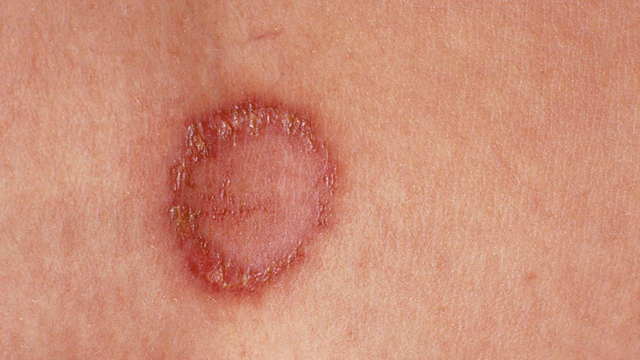 Ringworm: Symptoms, causes, diagnosis and treatments