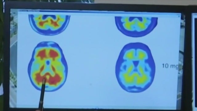 Second Alzheimer's drug in pipeline can slow the disease by a few months but with safety risk