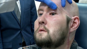 World's first full human eye transplant enhances face restoration