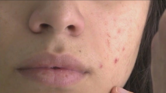 Basic skincare tips for teens amidst TikTok craze