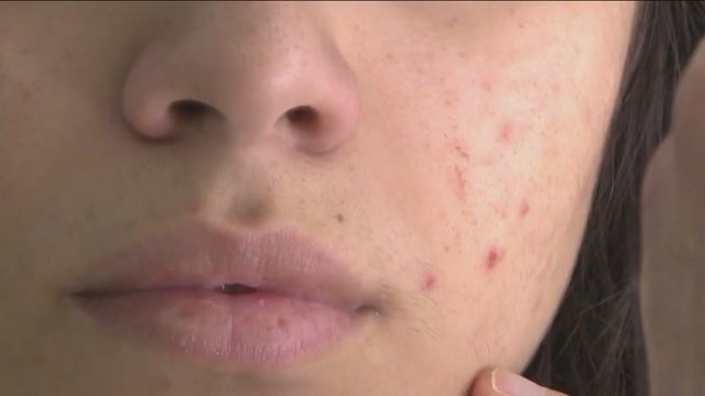 Basic skincare tips for teens amidst TikTok craze