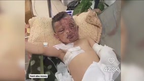 4-year-old from Gaza gets treatment in NYC after bombing destroyed his home, killed entire family