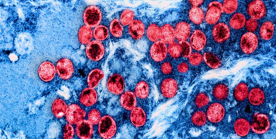 Mpox declared global health emergency by WHO as new form of the virus spreads