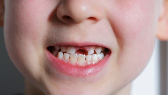 Tooth fairy tightens purse strings as payouts drop for second year