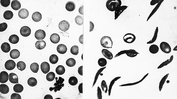 Sickle cell patient declared disease free after groundbreaking therapy on Long Island